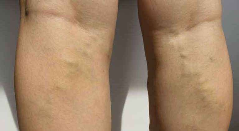Varicose Veins 1